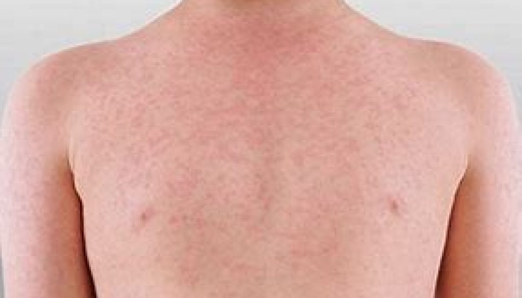 The US Has Nearly 900 Measles Cases, and 10 States Have Active Outbreaks